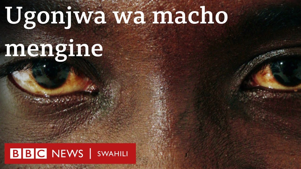 Mlipuko wa Ugonjwa wa macho wa Conjunctivitis