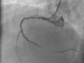 Angioplasty during ongoing heart attack by dr siddharth dagli