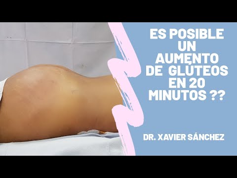 Aumento de glúteos| Dr Xavier Sánchez| Esculpiendo tus sueños