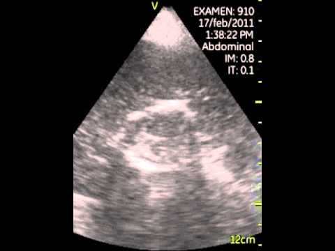 VSCAN, hydatid cyst, pocket ultrasound, quiste hidatidico