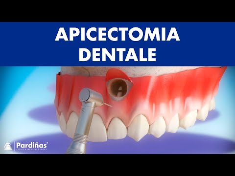 Video: Una Cisti Sulla Gomma Di Un Dente - Sintomi, Conseguenze E Trattamento Di Una Cisti Sulla Gomma Con Rimedi Popolari, Rimozione