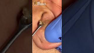 GOLDMINE OF BLACKHEADS II SUPER SATISFYING BLACKHEAD REMOVAL BY DR.LALIT KASANA