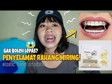 Cara Pakai & Fungsi ELASTIC BAND orthodontic untuk rahang gigi renggang/miring saat di behel