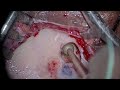 RIGHT COCHLEAR IMPLANTATION IN AN EXTREMELY FORWARD LYING SIGMOID SINUS WITH SUPERIOR MASTOID ANTRUM