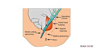 Episiotomy آموزش عمل جراحی پارگی پرینه و اپیزیوتومی