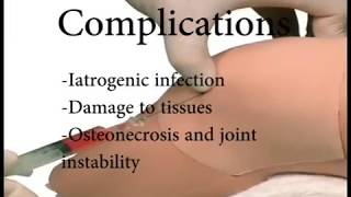 Knee Aspiration