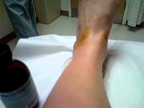 Steroid injection in foot recovery
