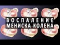 Воспаление мениска коленного сустава