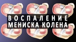 видео Воспаление мягких тканей: лечение и симптомы