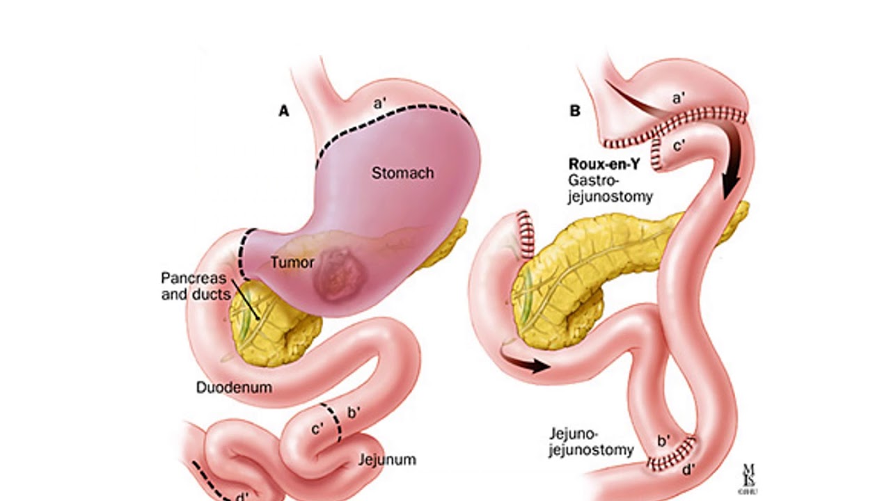 Почему после удаления желудка. Гастрэктомия хирургия. Тотальная гастрэктомия анастомоз. Операция гастроэктомия желудка. Тотальная гастроэктомия желудка.