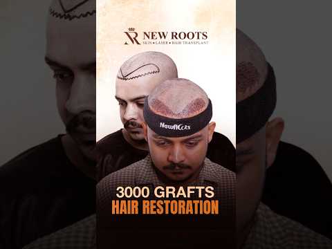 3000 Grafts for Hair Restoration | Patient Shares His Experience #shorts