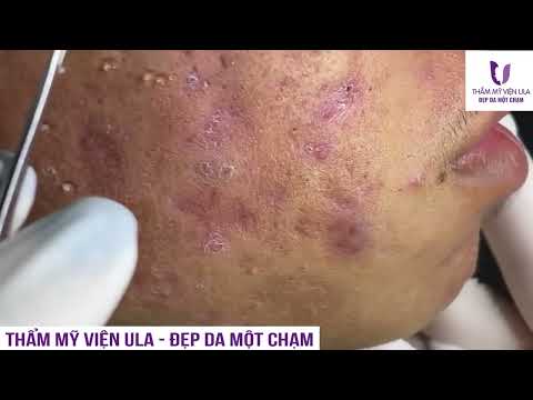 Video PHA NẶN MỤN KINH ĐIỂN KHÔNG NÊN XEM KHI ĐANG ĂN - youtube