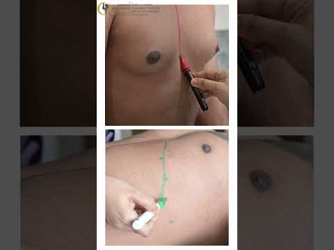 Tired of Stubborn Fat? Safe Liposuction & Body Contouring!