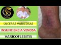 ULCERA VARICOSA  - INSUFICIENCIA VENOSA - VARICOFLEBITIS - Luis Antonio Melón