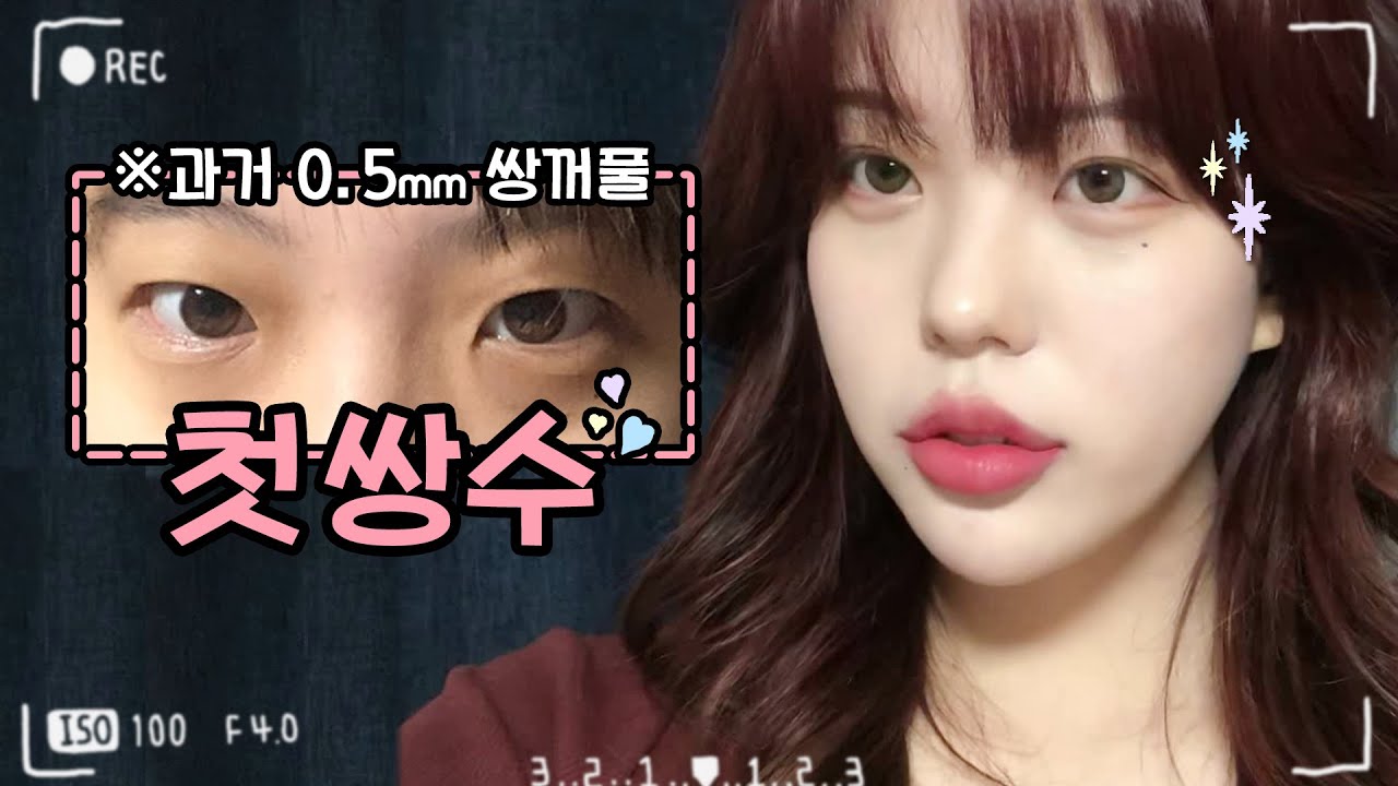 쌍수 내생에 첫성형|쌍꺼풀수술로 이렇게 달라진다고?👀 쌍수 당일부터 5개월차 전후차이 공개👉 (앞트임, 쌍꺼풀, 인아웃라인 ...