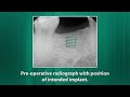 Onestage immediate placement of a 50 x 60mm short implant for a mandibular molar