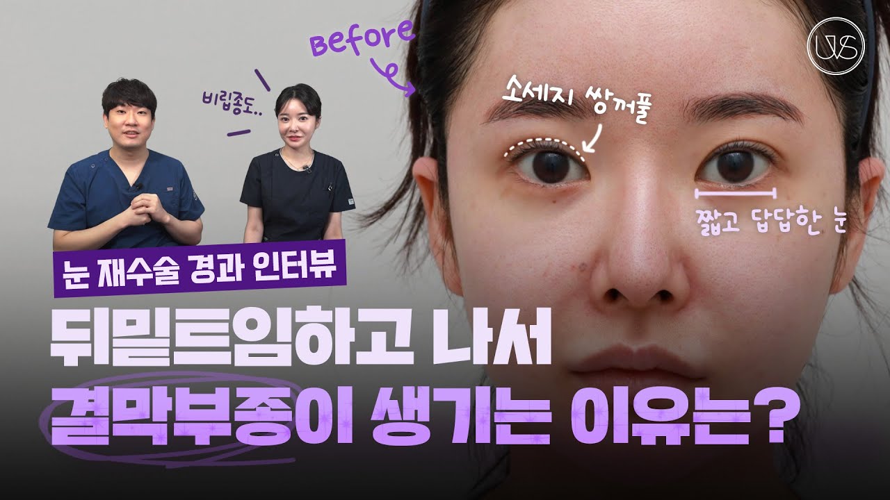 [Вивэрс гоо сайхны мэс заслын эмнэлэг] Нүдний давтан мэс засал хийлгээд 2 сар болоход ямар харагдах бол?! Нүдний давтан мэс заслын сэтгэл ханамжийг оноогоор хэлбэл…!