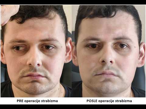 Estetska operacija strabizma i lasersko skidanje dioptrije, specijalna bolnica Sveti Vid