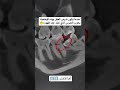 عندما يكون بوضع مائل أو منطمر جزئيا يسبب انحشار بقايا الطعام والجراثيم وتآكل بالسن الذي قبله التهاب