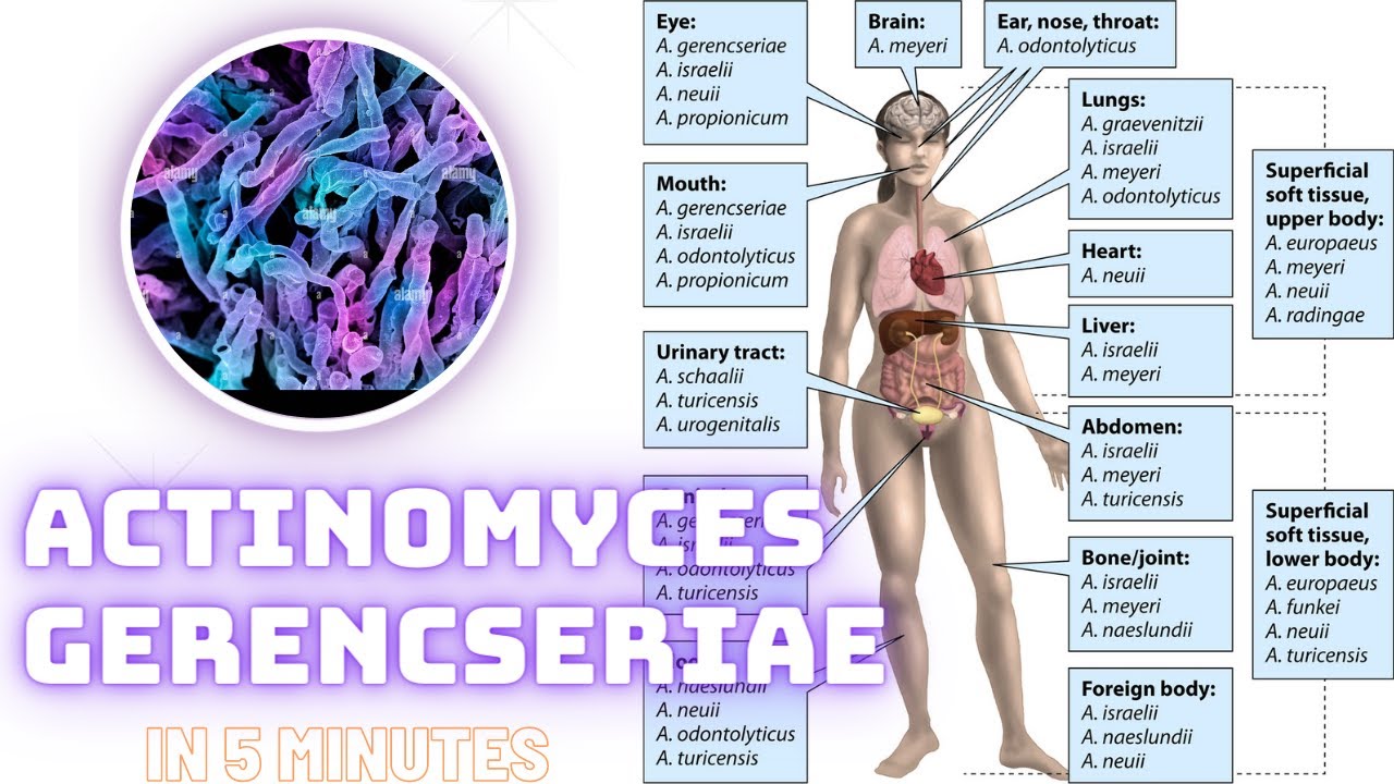 Actinomyces Radingae actinomyces microbiology lecture ||actinomyces gerencseriae ||Easy ...