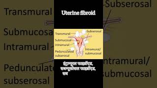 uterinefibroid noncancerous leiomyomas tumor uterus Intramural Submucosal Subserosal