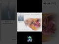 INTRAUT£RINE INSEMINATION (IUI)