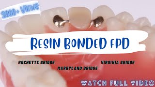 RESIN BONDED FPD || ROCHETTE BRIDGE || MARRYLAND BRIDGE ...