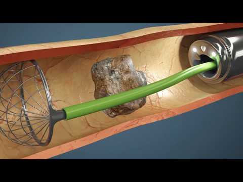 Como é feita a Cirurgia de Pedra nos Rins? Vídeo da cirurgia em 3D