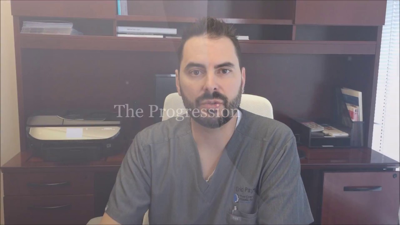 After Jaw Surgery - week 5 - Finger Stretch Exercise