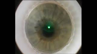 Zeiss Visumax 500 LASIK Flap Black Spots MGD