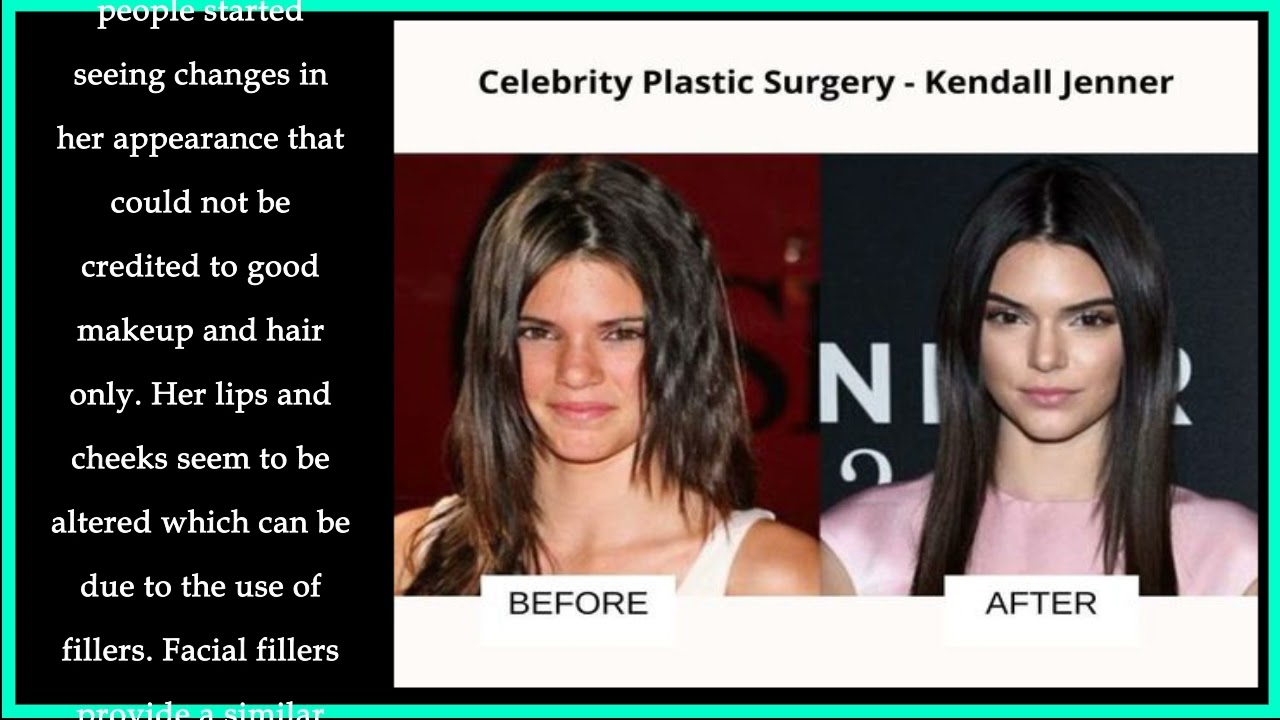 Kendall Jenner Plastic Surgery Before And After Then And Now Youtube