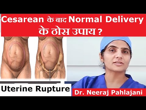 Cesarean के बाद Normal Delivery कैसे करे? Normal Delivery After C Section