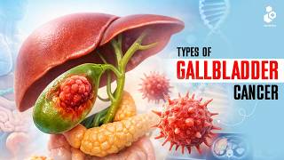 Types Of Gallbladder Cancer Explained In 3D Medical Animation Doctors Eremedium