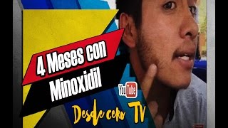 Crecimiento de la &quot;Barba&quot; con Minoxidil Cap 4