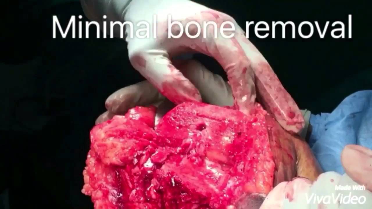 CEMENTED TOTAL KNEE REPLACEMENT - YouTube