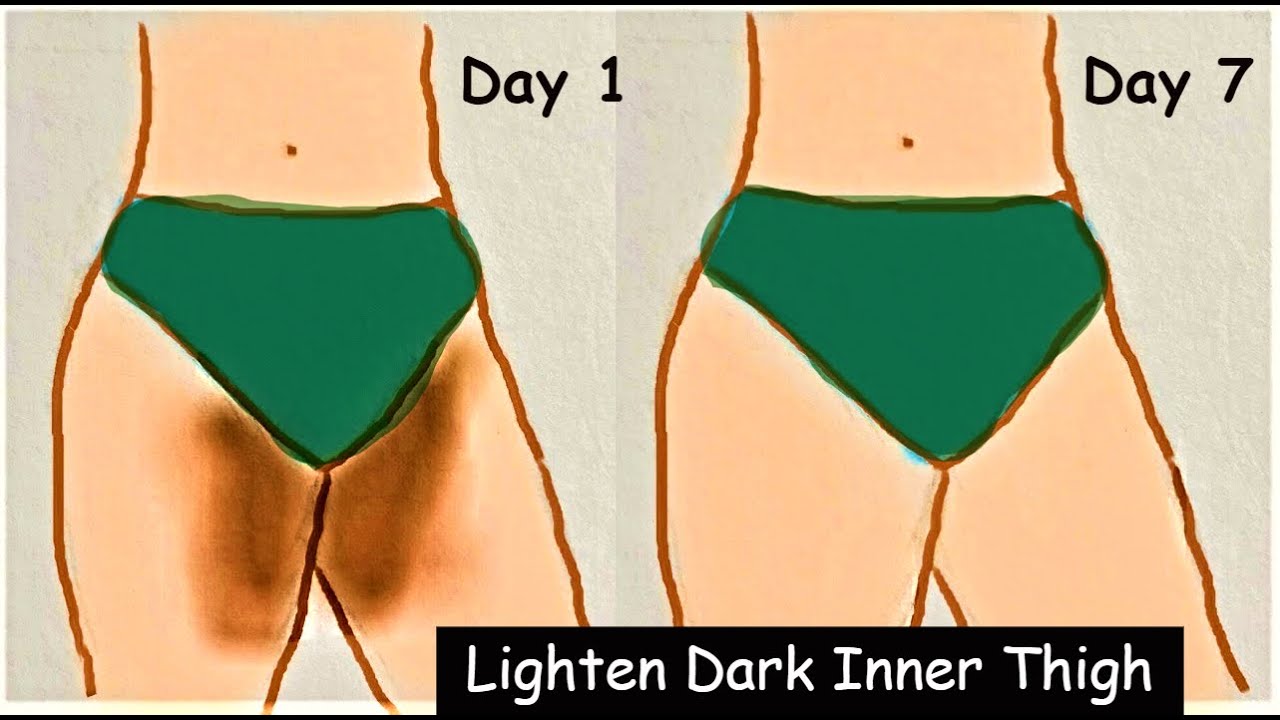 how-i-lighten-dark-inner-thigh-in-7-days-skin-lightening-dark-private