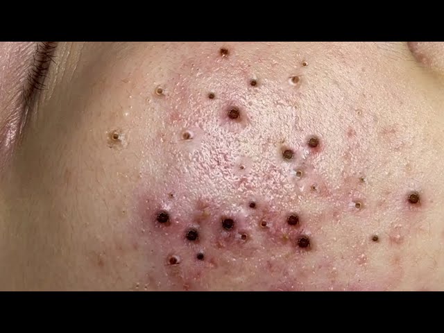 treatment of blackheads and hidden acne at nasa 123#beauty#viral