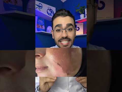 راي دكتور حسن مجدي فى كريم تقشير البشرة ميلا اوف كريم تقشير بارد منزلي