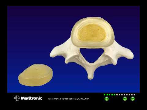 Video: Anatomie, Functie En Diagram Van Tussenwervelschijf - Lichaamskaarten