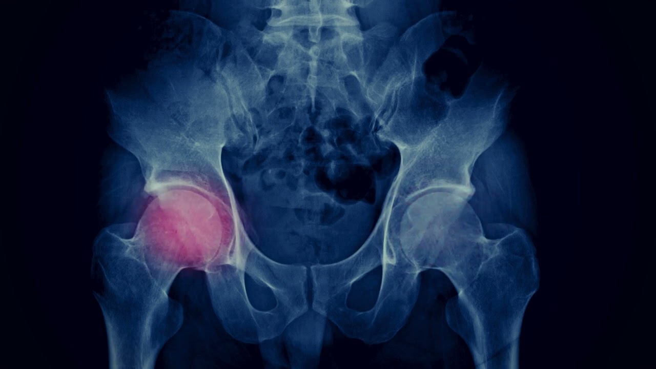 Hip Pain Relief Therapy - Pure Isochronic Tones & Binaural Beats | 15-Minute Rife Healing Session