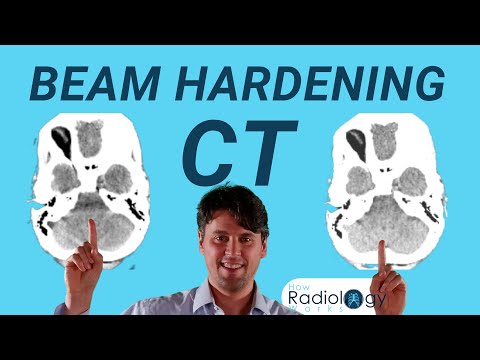 Video: Hva er artefakter på CT-skanning?