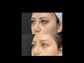 Under eye filler treatment with pa cathy  ageless md