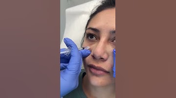 Under Eye Filler Treatment with PA Cathy - Ageless MD