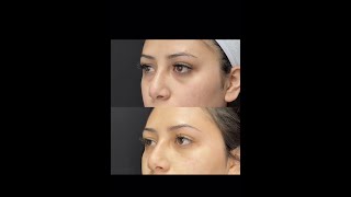 Under Eye Filler Treatment with PA Cathy - Ageless MD screenshot 3