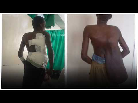 Yavuwe ikibyimba cy’ibiro 15 yari amaranye imyaka 15 | Uko operation yagenze | Amasaha 6 adasanzwe