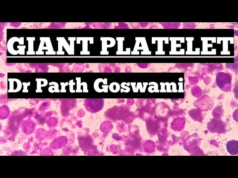 Giant Platelet || Causes of Giant Platelet || Morphology in Peripheral Smear examination || Images