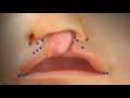 Cleft Lip Repair - Surgical Markings