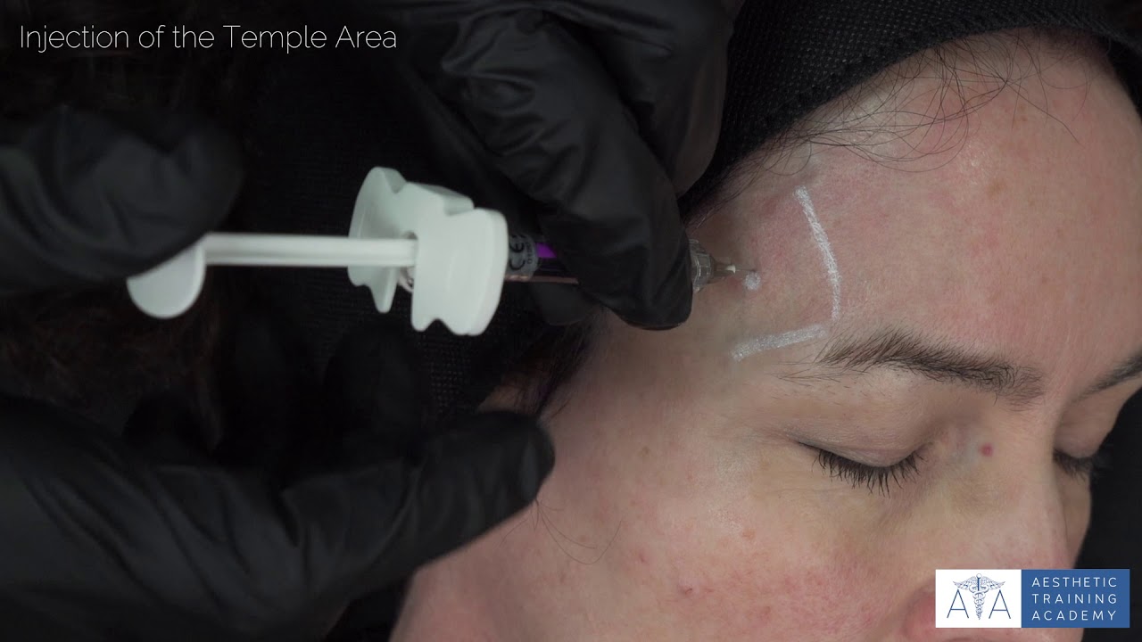 Injection of the Temple Area - YouTube