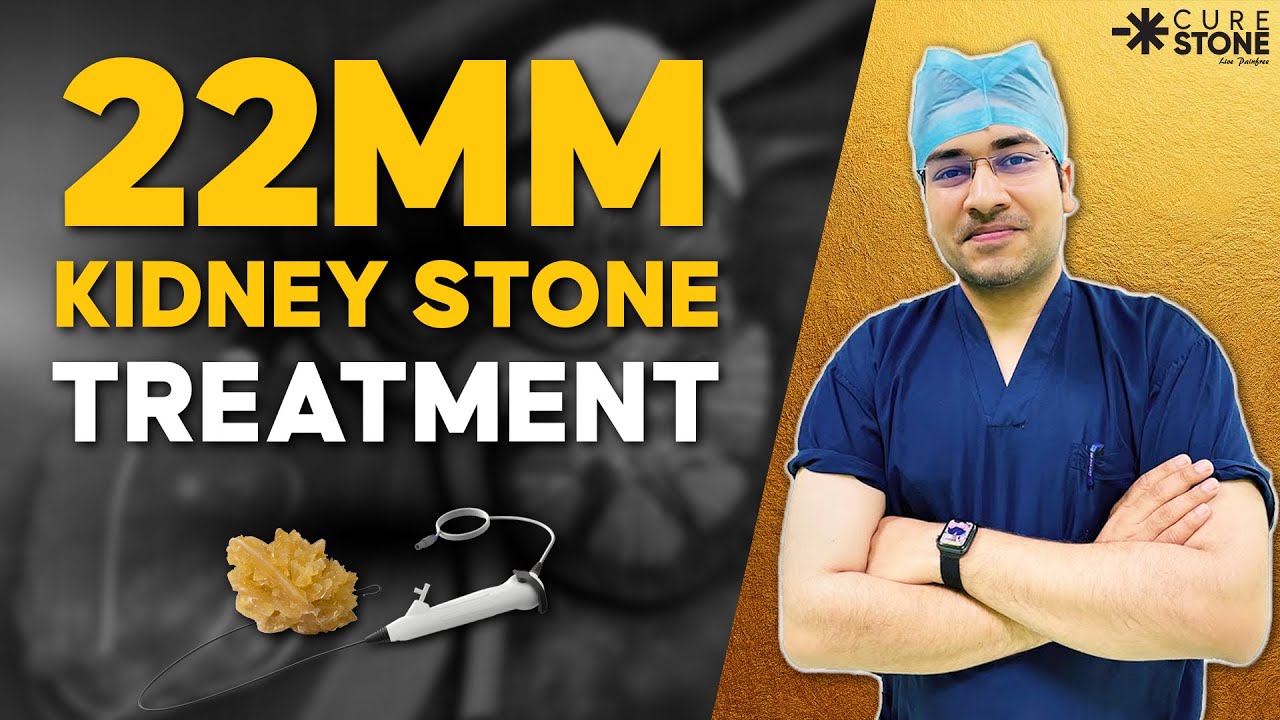 22mm Kidney Stone Treatment | 4 Failed Surgeries to Success, Patient Success Story from Shimla, RIRS