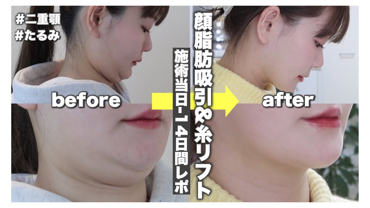 【小顔整形】脂肪吸引&糸リフトDT14日間レポ！矯正後の輪郭悩み/施術当日の痛み/経過/変化等【細かくレポ】